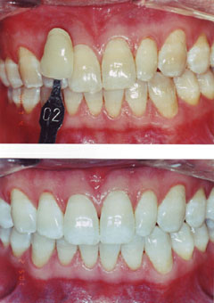 toothwhitening02