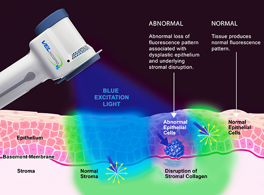 VELscope Oral Cancer Screening