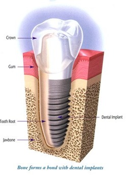 drschwan_implant